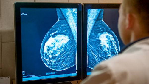 40 yaş üstü kadınlara ücretsiz mamografi taraması 40 yaş üstü kadınlara ücretsiz mamografi taraması